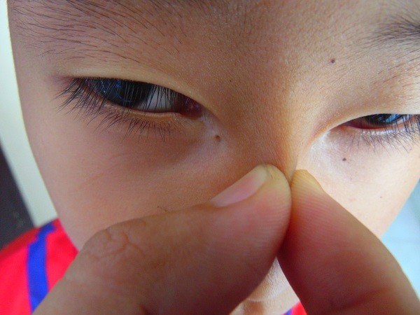 bệnh nhân có 2 tuyến lệ