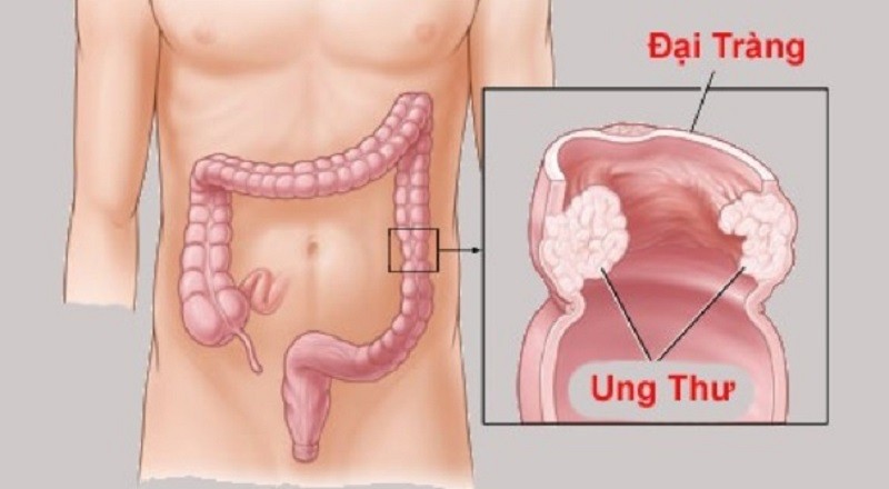 ung-thu-dai-truc-trang