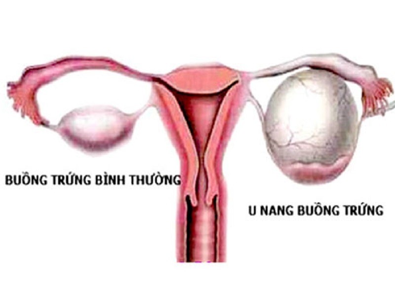 Phẫu thuật điều trị u nang buồng trứng tại Bệnh viện Hữu nghị Lạc Việt 1 trieu-chung-va-cach-dieu-tri-u-nang-buong-trung