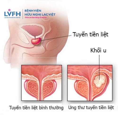 5 bệnh ung thư thường gặp ở nam giới
