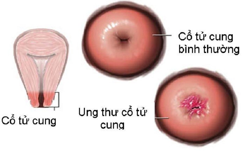 Chẩn đoán ung thư sớm giúp điều trị có kết quả cao