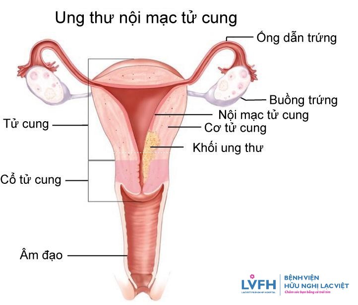 5 bệnh ung thư thường gặp ở phụ nữ