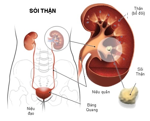 Cách nhận biết sỏi niệu quản và phương pháp điều trị