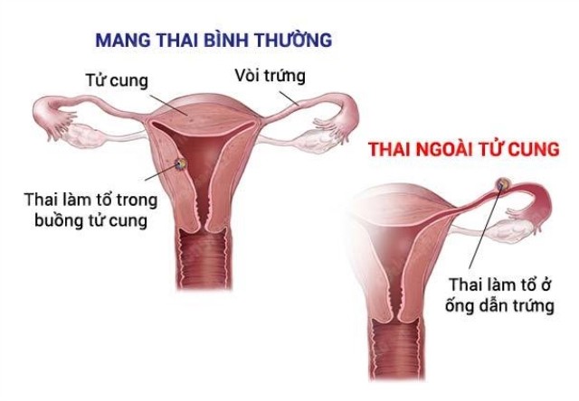 Cấp cứu thai ngoài tử cung