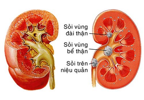 phuong phap dieu tri soi nieu quan 1