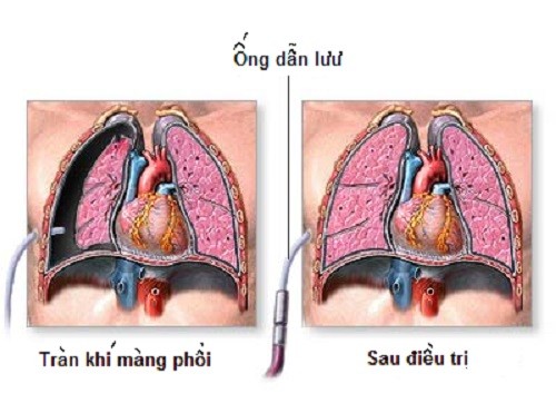 phuong phap dieu tri tran dich mang phoi 2