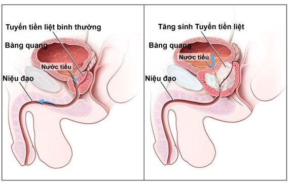 trieu chung canh bao u xo tuyen tien liet