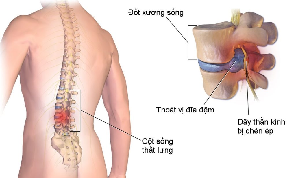 Chụp cộng hưởng từ MRI cột sống, thắt lưng