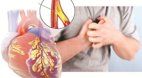 Dấu hiệu đầu tiên của bệnh mạch vành: Đau ngực trái