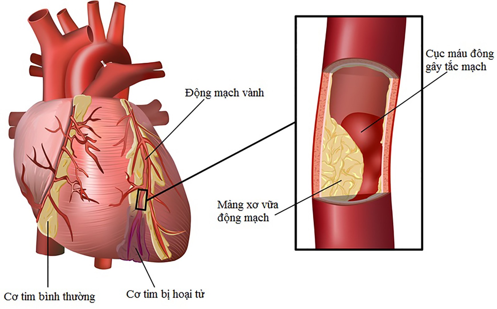 dau hieu dau tien cua benh mach vanh dau nguc trai