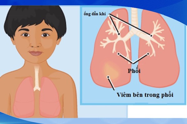 huong dan cham soc khi tre bi viem phoi 1