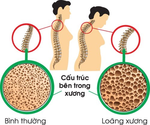 huong dan dieu tri loang xuong o phu nu man kinh