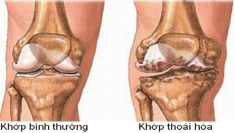chụp mri khớp gối