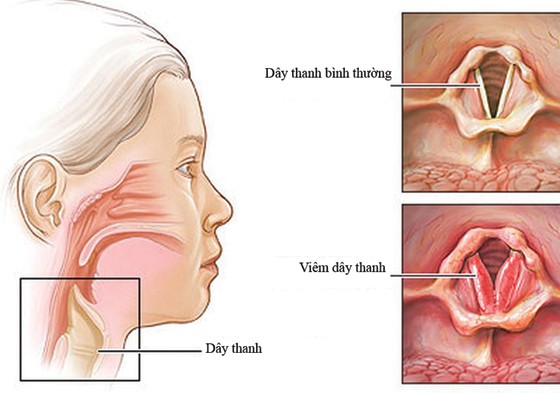 trieu chung va cach dieu tri viem day thanh quan 1