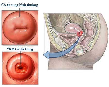 dau hieu nhan biet viem co tu cung ban nen biet 1