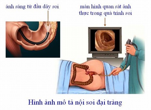 khi nao can thuc hien noi soi dai trang 1