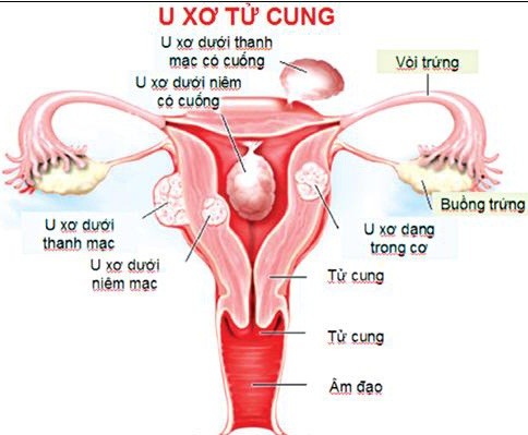 u xơ tử cung