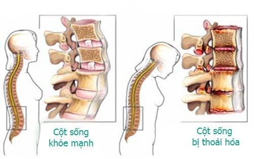 thoai hoa cot song va phuong phap dieu tri 1