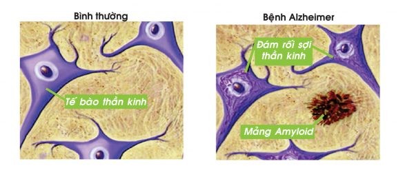 alzheimer va trieu chung thuong gap cua benh 1