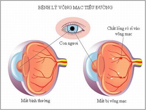 Bệnh tiểu đường type 2 có nguy hiểm không? 2 benh tieu duong type 2 co nguy hiem khong 2
