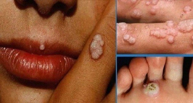hpv co gay vo sinh khong 2