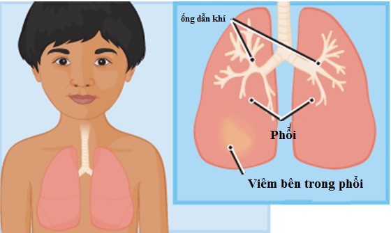 benh viem phoi o tre em benh vien huu nghi lac viet