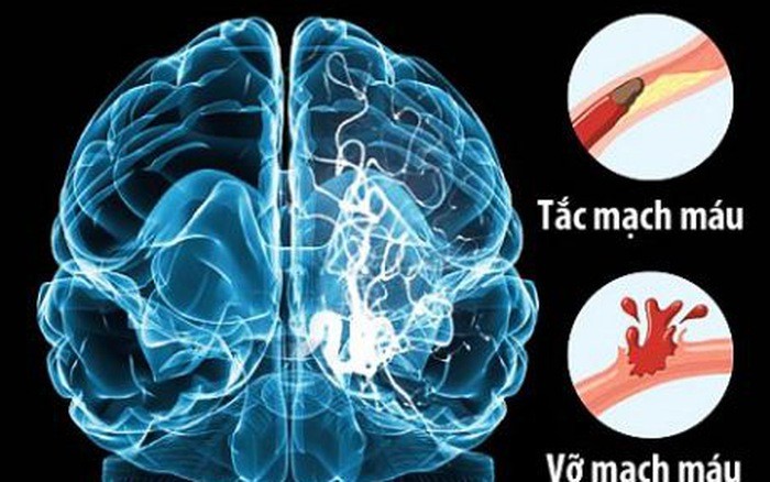 10 dấu hiệu của đột quỵ không thể bỏ qua 1 10 dau hieu cua dot quy khong bo qua 2