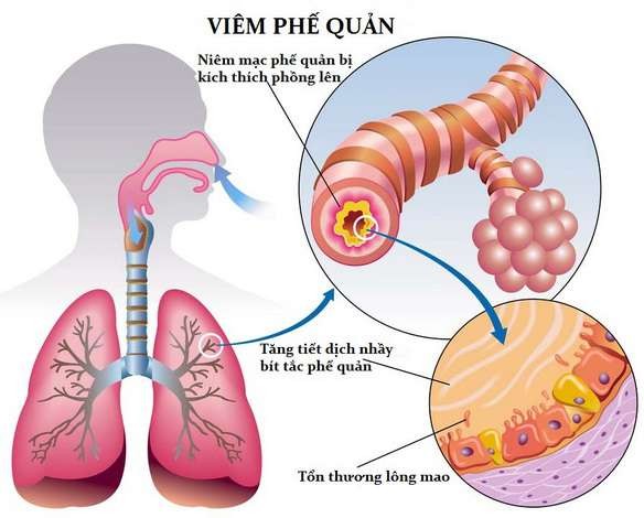 nguyen nhan dan den viem phe quan cap o tre em