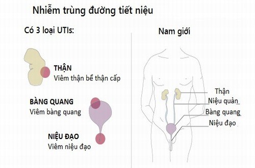 nhiem trung duong tieu co nguy hiem khong 1