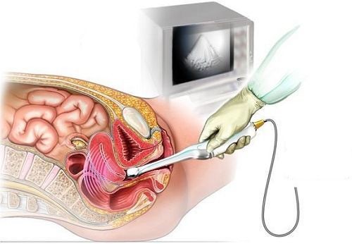 Siêu âm đầu dò có hại không?
