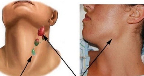 4 dấu hiệu cảnh báo ung thư vòm họng dễ bị bỏ qua nhất 1 4 dau hieu canh bao ung thu vom hong de bi bo qua nhat
