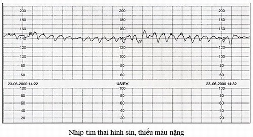 Theo dõi nhịp tim thai và cơn co tử cung bằng monitor sản khoa 2 theo doi nhip tim thai va con co tu cung bang monitor san khoa 2
