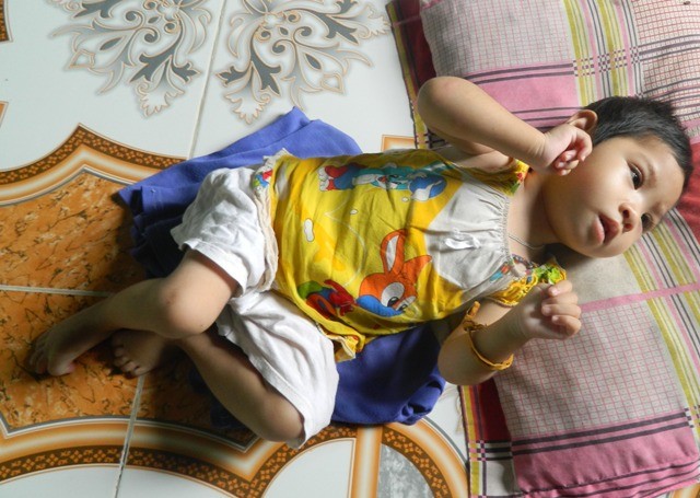 động kinh trẻ em