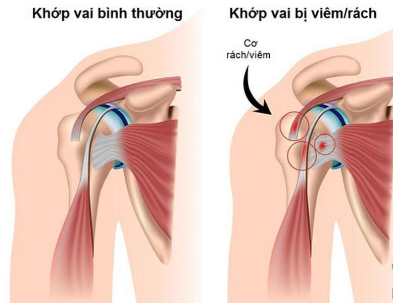 dieu tri viem quanh khop vai 1