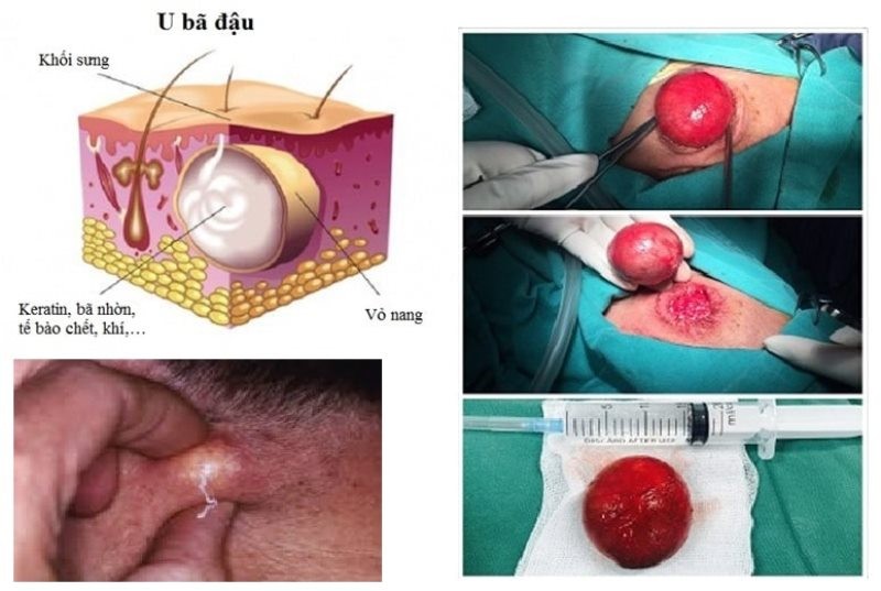 dieu tri viem u ba dau nhu the nao 2
