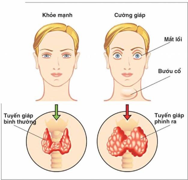 Lời khuyên cho người mắc bệnh cường giáp 1 loi khuyen cho nguoi mac benh cuong giap 1