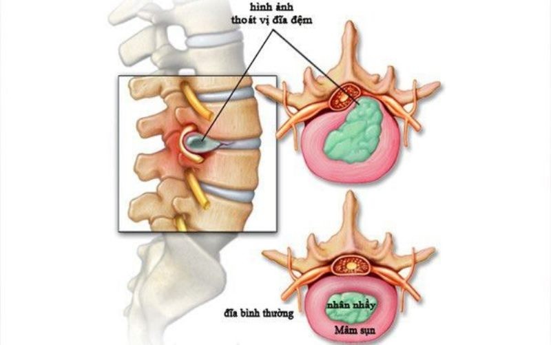 Nên điều trị thoát vị đĩa đệm ở đâu? 1 nen dieu tri thoat vi dia dem o dau 1