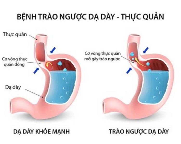 Nguyên nhân và biểu hiện trào ngược dạ dày thực quản 2 nguyen nhan va bieu hien trao nguoc da day thuc quan 2