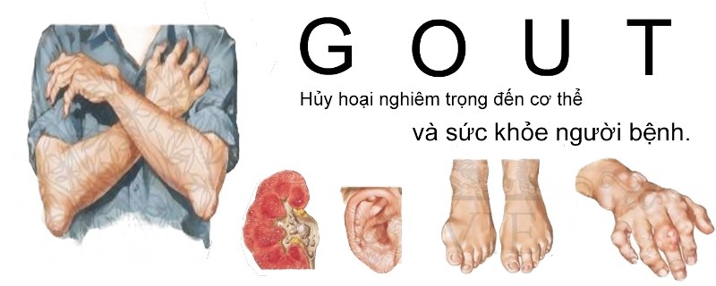 Thực phẩm người mắc bệnh Gout cần tránh xa