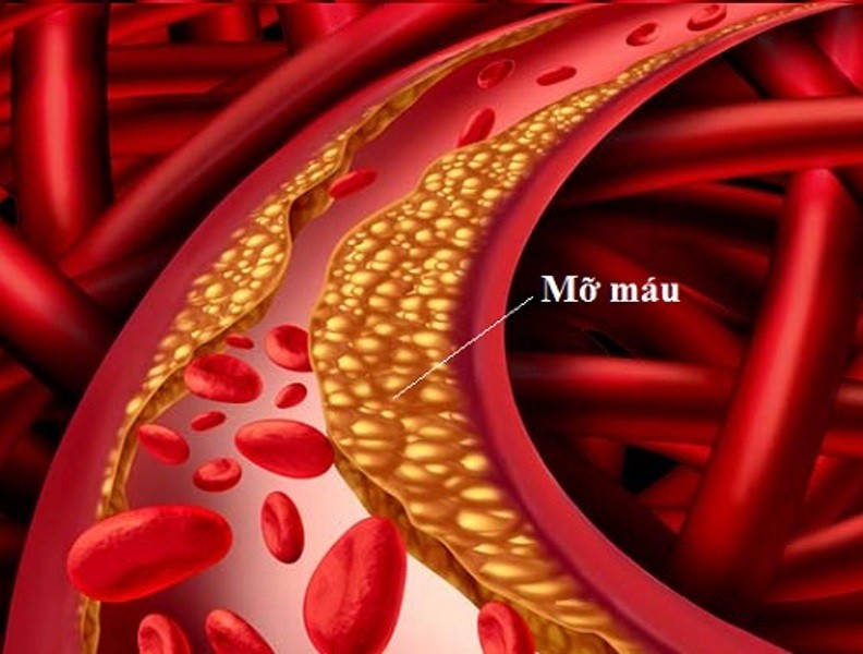Chỉ số mỡ máu cao nên ăn gì cho tốt?