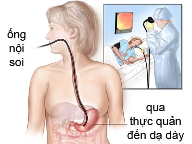 nội soi dạ dày