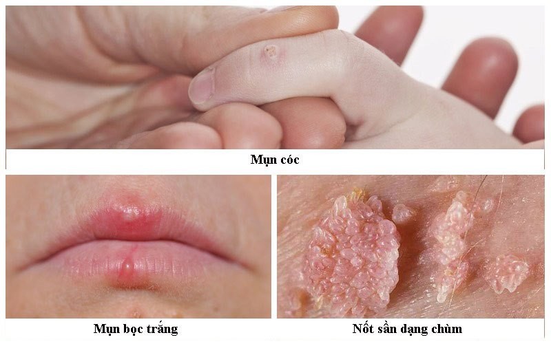 hpv la gi va nhung van de lien quan 3