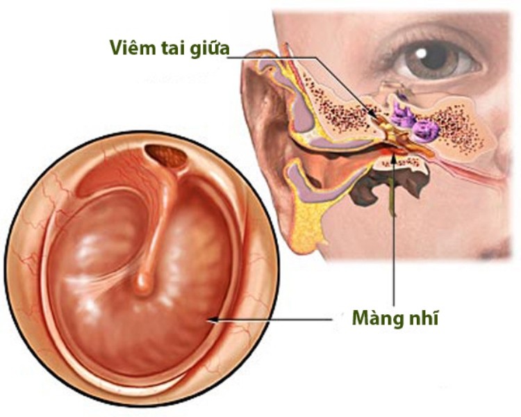 be bi viem tai giua cha me can luu y nhung gi 1
