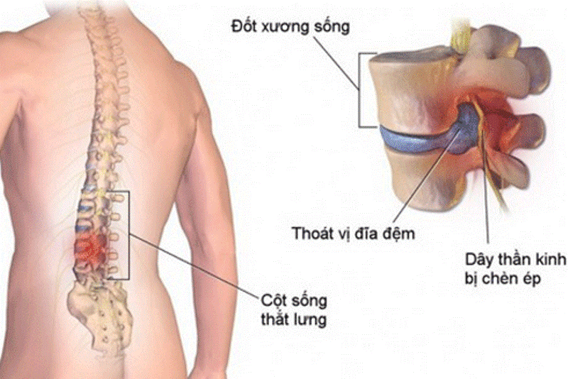 benh vien huu nghi lac viet tu van suc khoe benh thoat vi dia dem va cach dieu tri