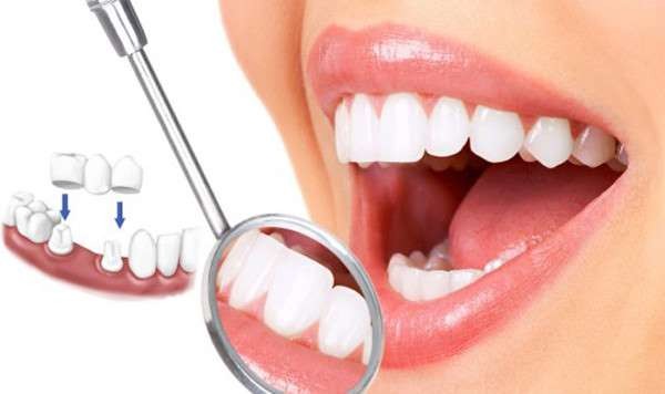 Răng thẩm mỹ: Chọn bọc chụp răng sứ hay mặt dán sứ?