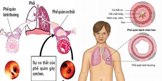 Hen phế quản ở trẻ em