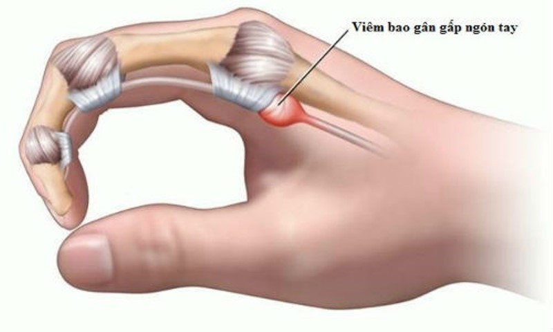 viem gan gap ngon tay ngon tay lo xo 1