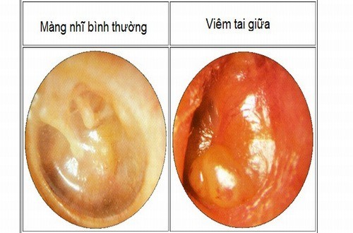 Viêm tai giữa ở trẻ em: Nguyên nhân và cách điều trị