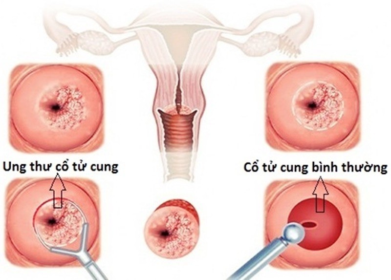 cac dau hieu canh bao ung thu co tu cung chi em phai den vien ngay khong duoc tri hoan 1