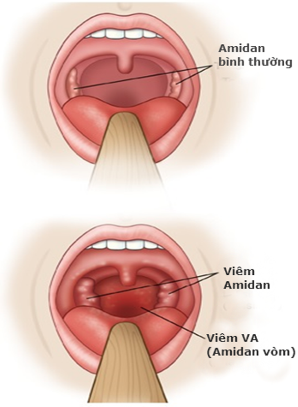 Cắt amidan khi đang mang thai nên hay không?